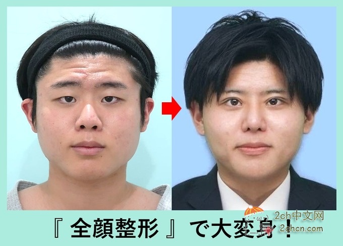 2ch：日本男子进行全脸整容的结果