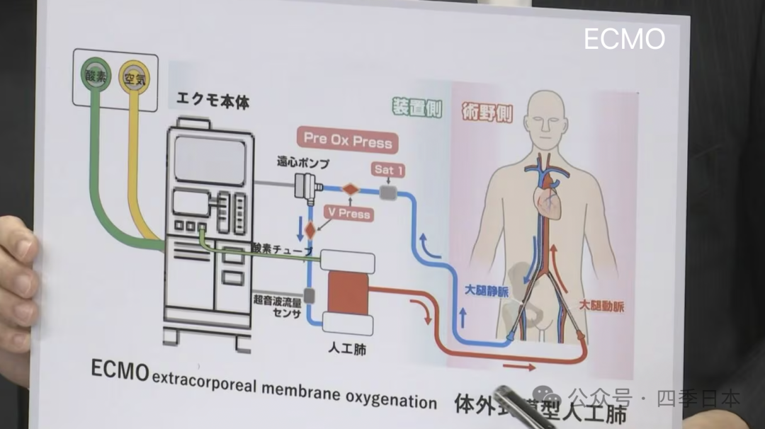 日本一医院重大失误！忘接ECMO氧气管致患者断氧20分钟昏迷危重