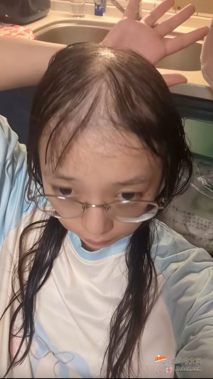 2ch：发现了一个患有“脱发症”的美少女